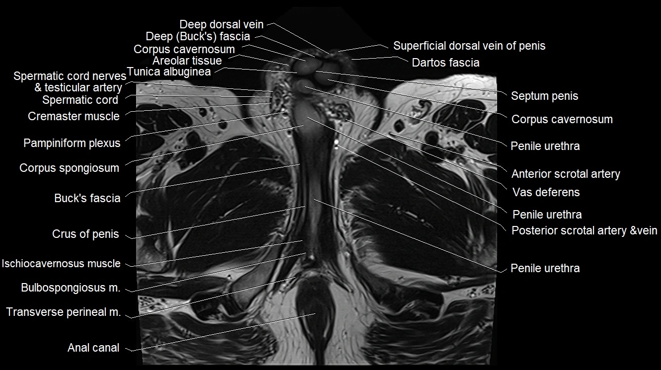 MRI 3T scrotum and penis axial cross sectional anatomy image 20.webp
